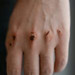 do plantar warts resolve spontaneously